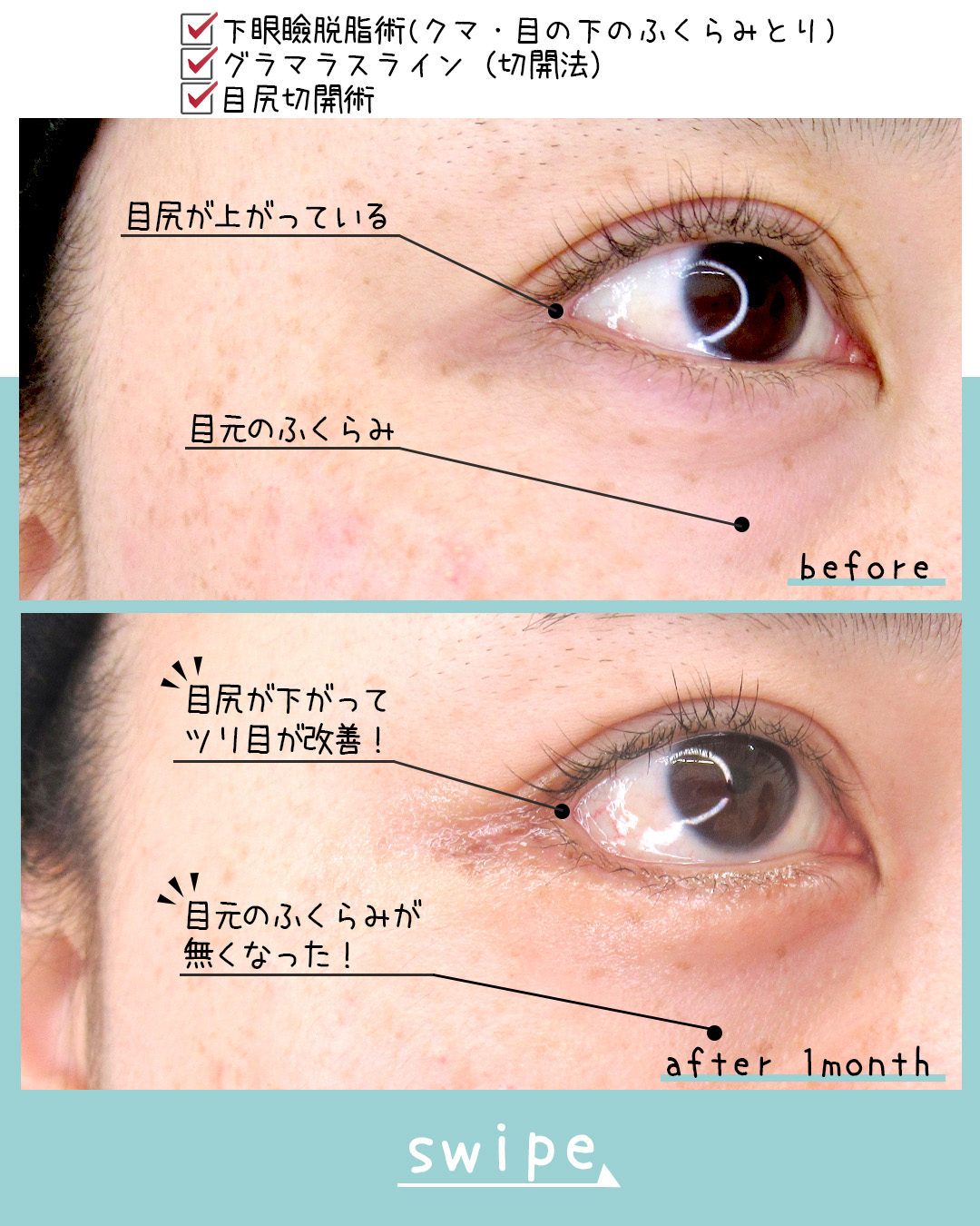 グラマラスライン（タレ目形成）/目尻靭帯移動術の症例写真 施術前後 