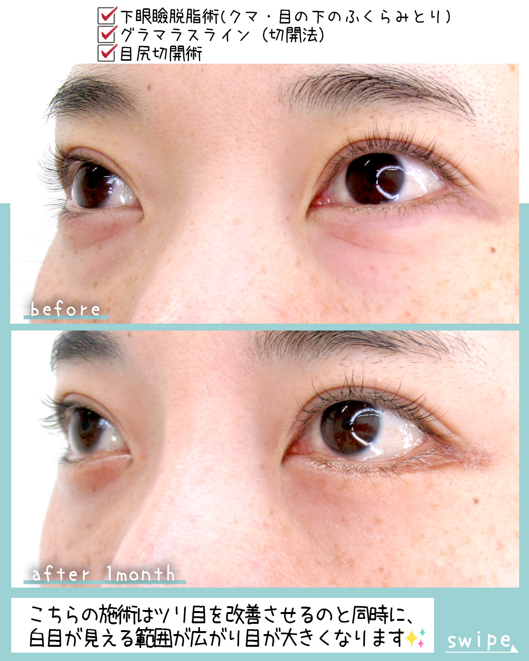 グラマラスライン（タレ目形成）/目尻靭帯移動術の症例写真 施術前後 