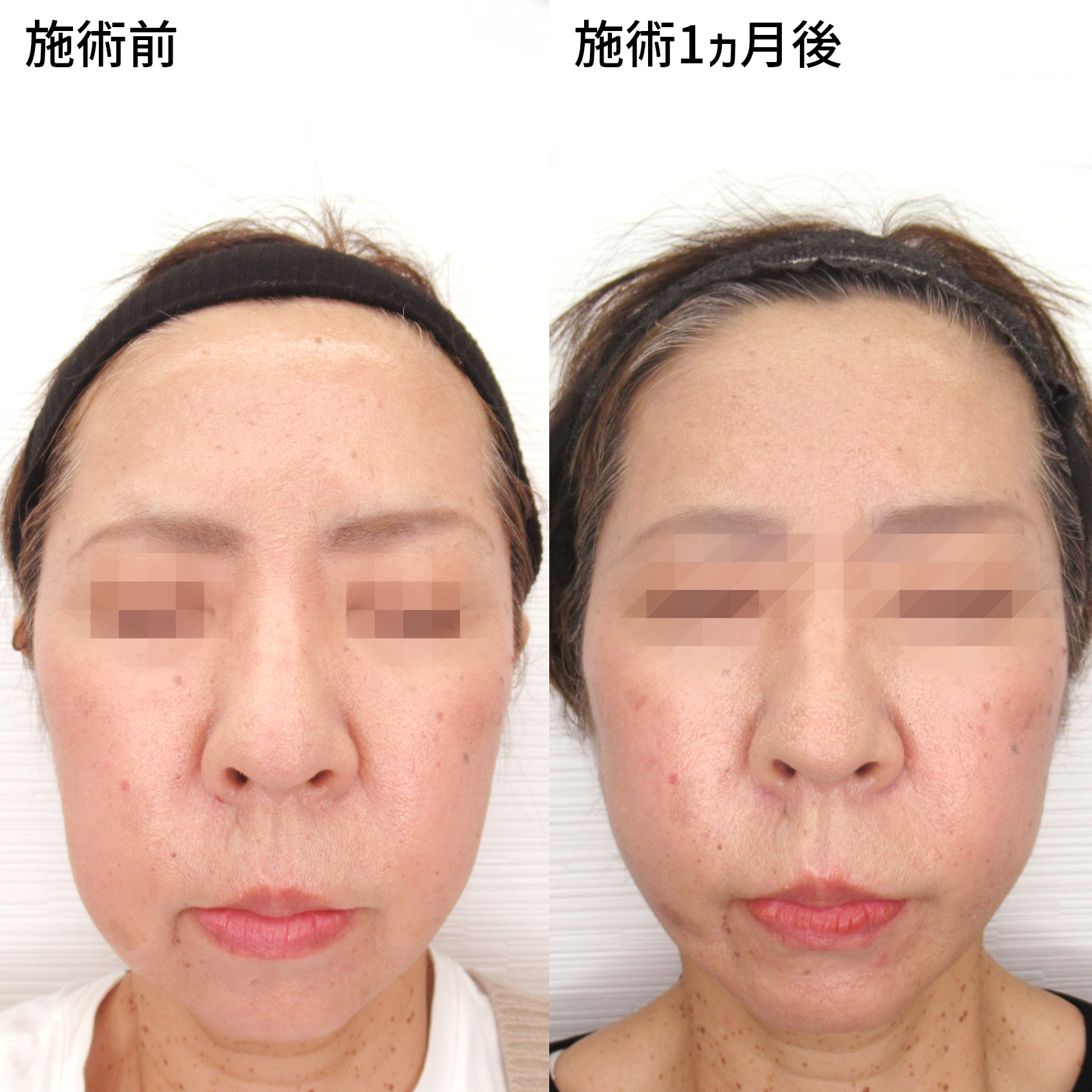 ジョールファット除去とツヤ肌コラーゲンリフトで口周りスッキリ