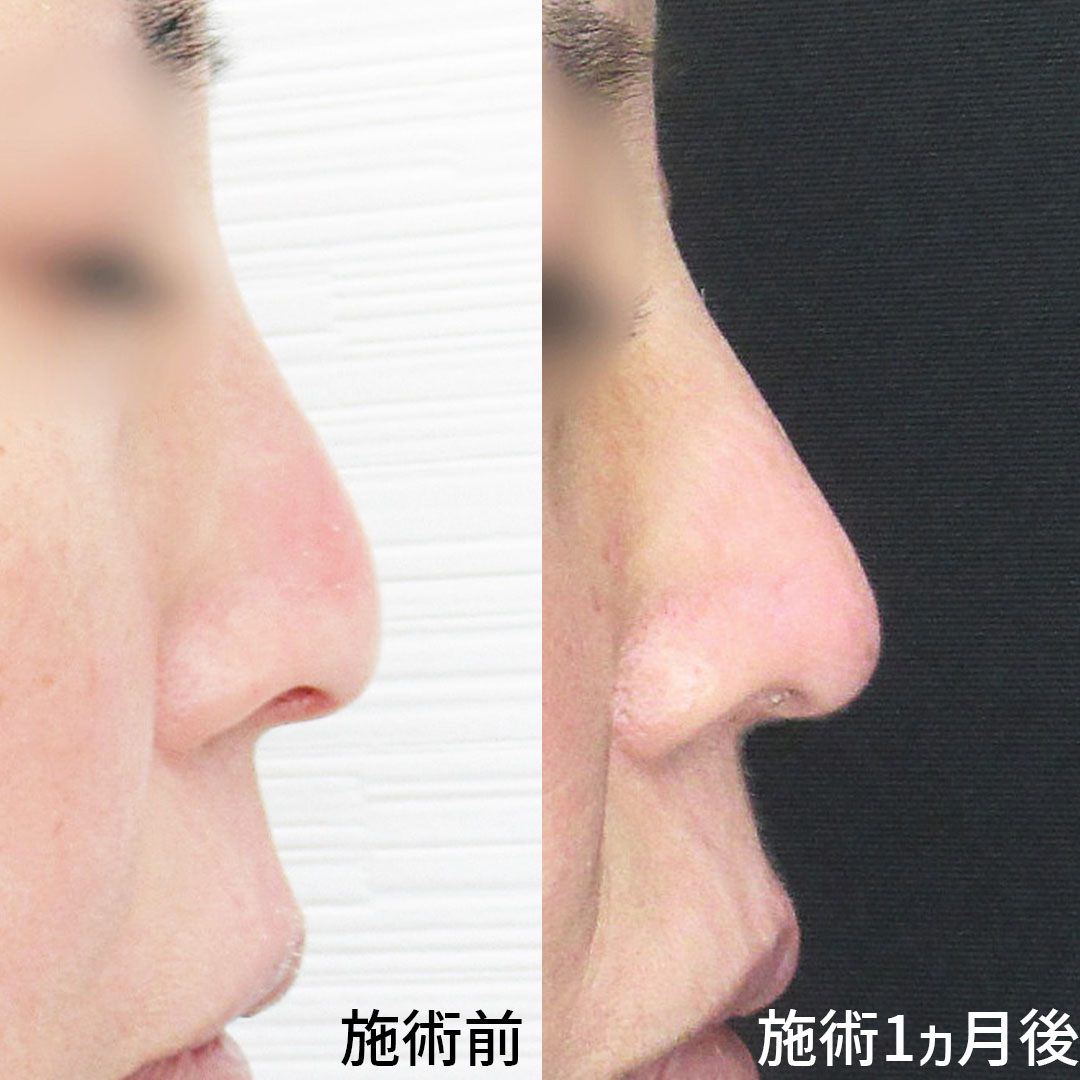 鼻尖4Dノーズ/鼻：その他の症例写真 施術前後 