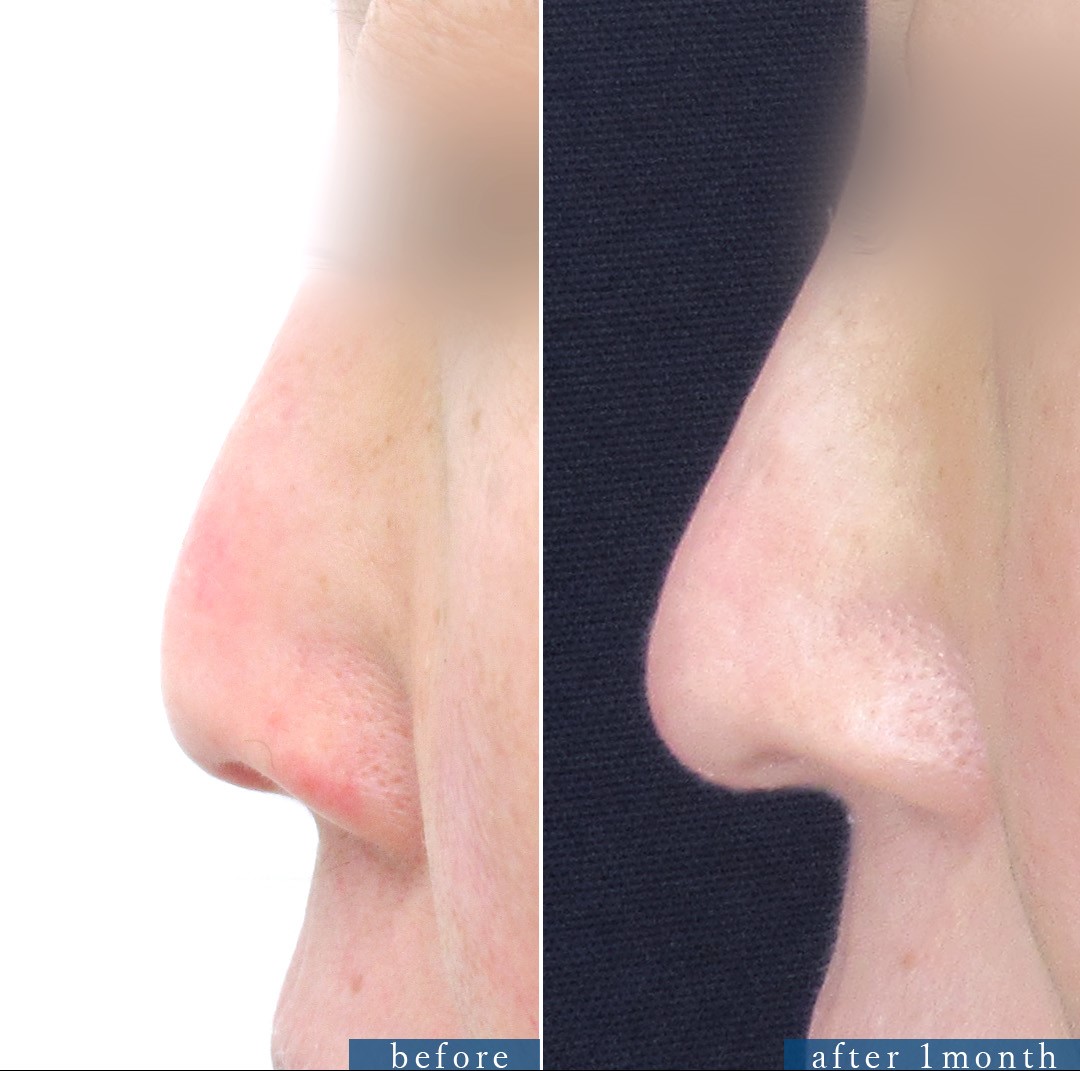 鼻尖4Dノーズ/鼻：その他の症例写真 施術前後 