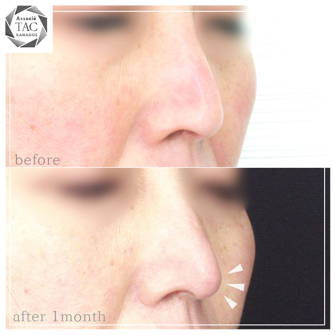 鼻尖4Dノーズ/鼻：その他の症例写真 施術前後 