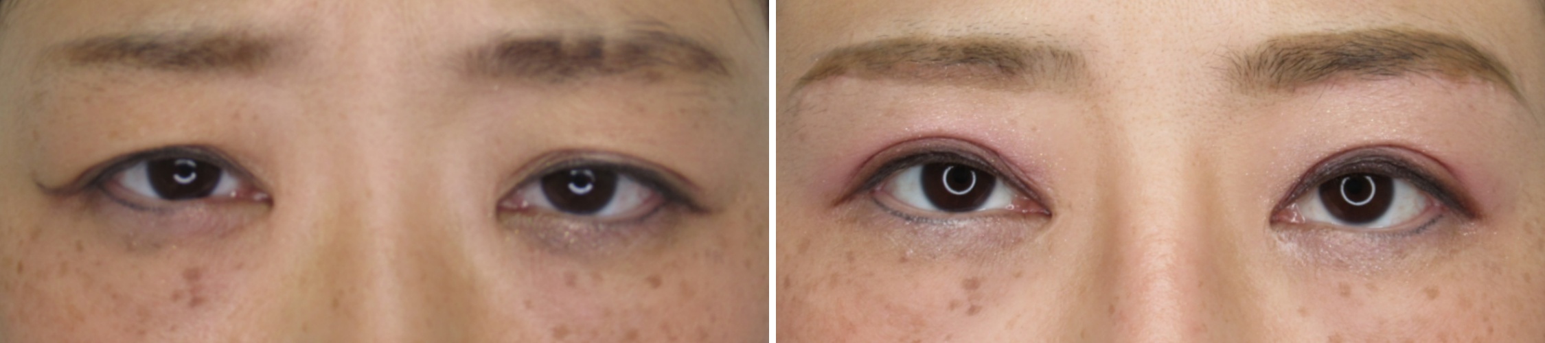 眉毛下切開術 眉下切開はバレる 眉下切開 の経過と腫れ 内出血 ダウンタイム 傷跡について Taクリニック 美容整形 美容外科 新宿 銀座 大阪 福岡 川越 高崎