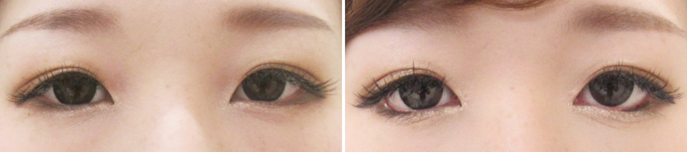 目頭切開とグラマラスラインで縦も横も大きく