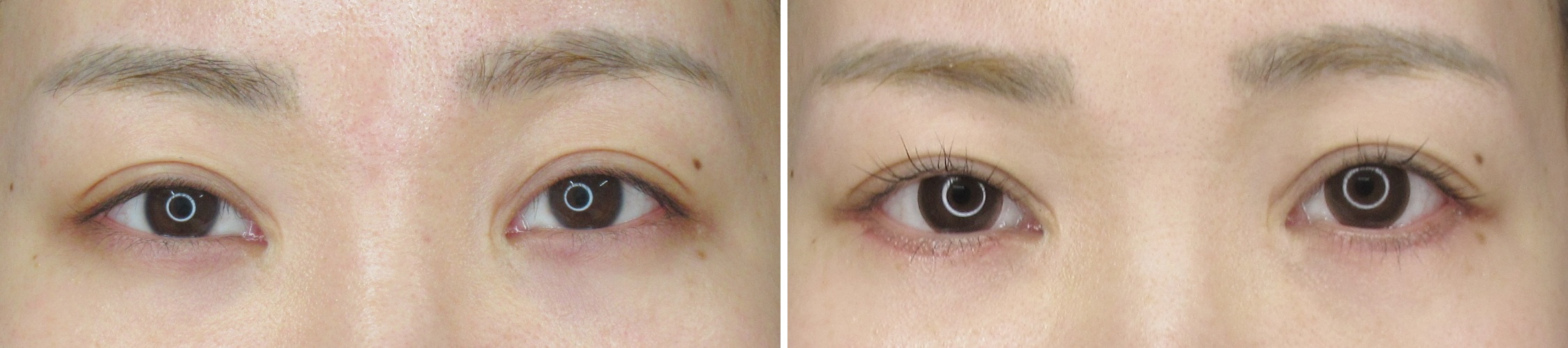 グラマラスライン切開と目尻切開術の複合施術