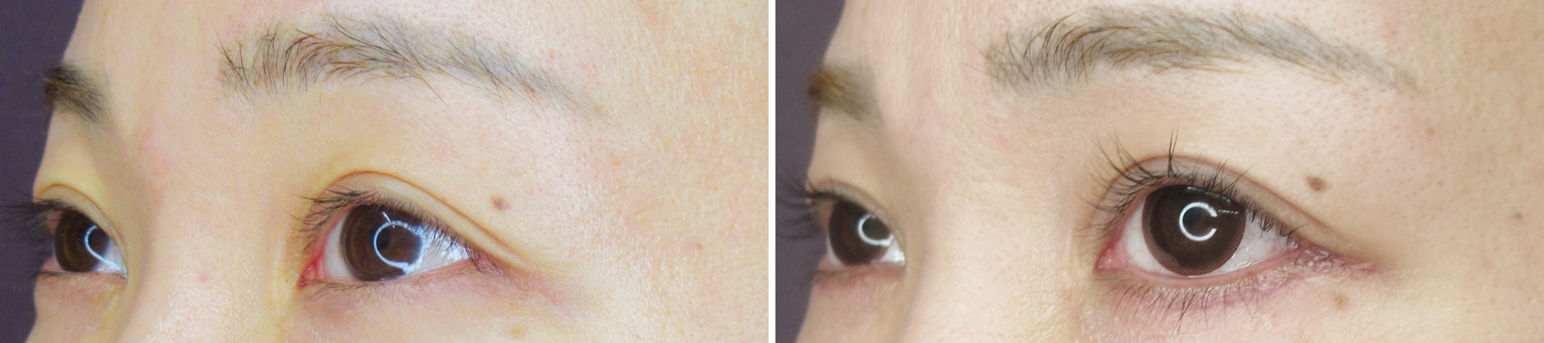 グラマラスライン（タレ目形成）/目尻切開術の症例写真 施術前後 1ヵ月後