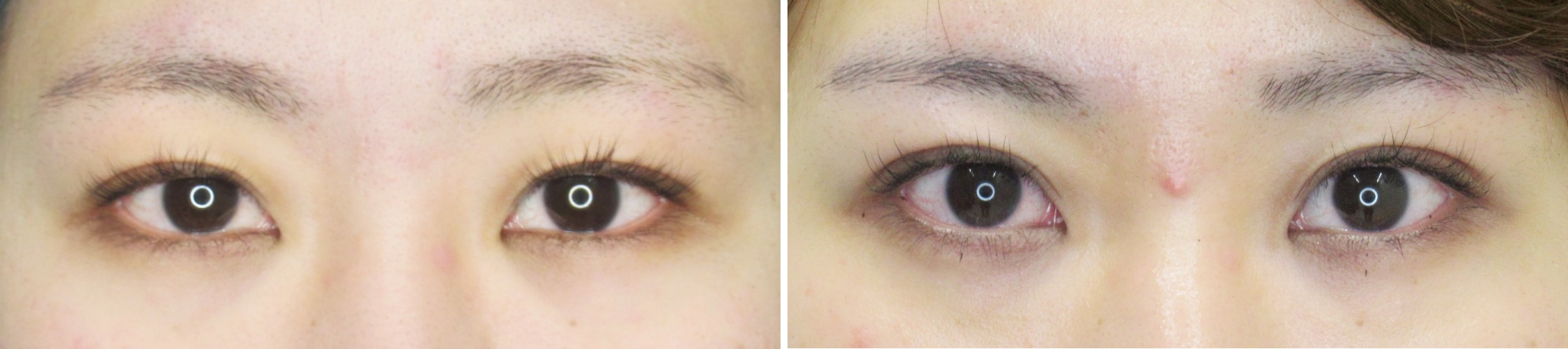 クイックコスメリングなら術直後から腫れも最小限に