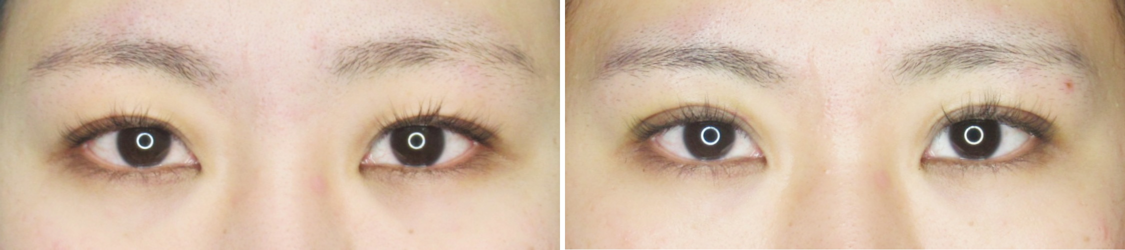 クイックコスメリングの症例写真 施術前後 1週間