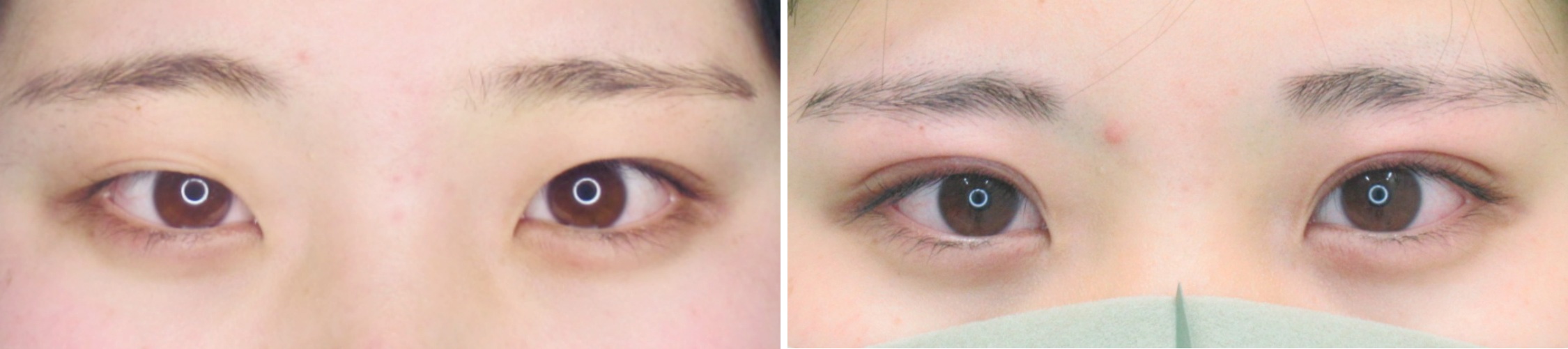 学生さんにもおすすめTACの二重埋没法