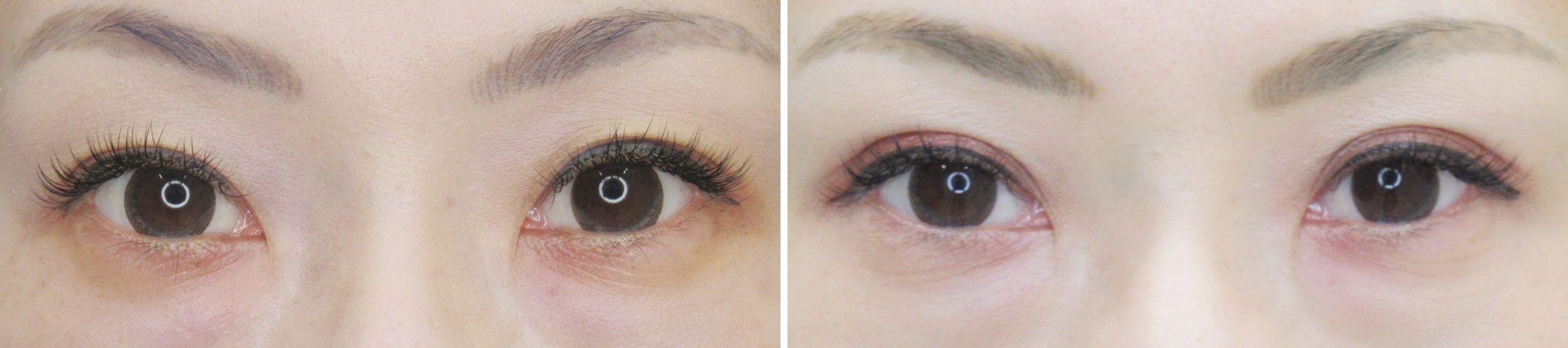 コスメリングで表に傷や糸玉を作らず理想の二重に