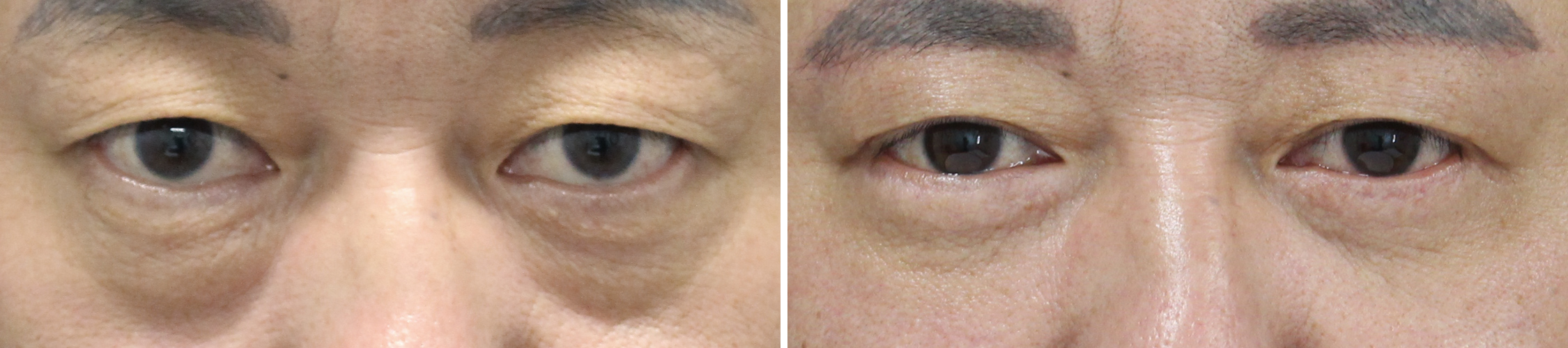 眉毛下切開術/下眼瞼切開術（クマ・たるみとり）の症例写真 施術前後 6ヵ月