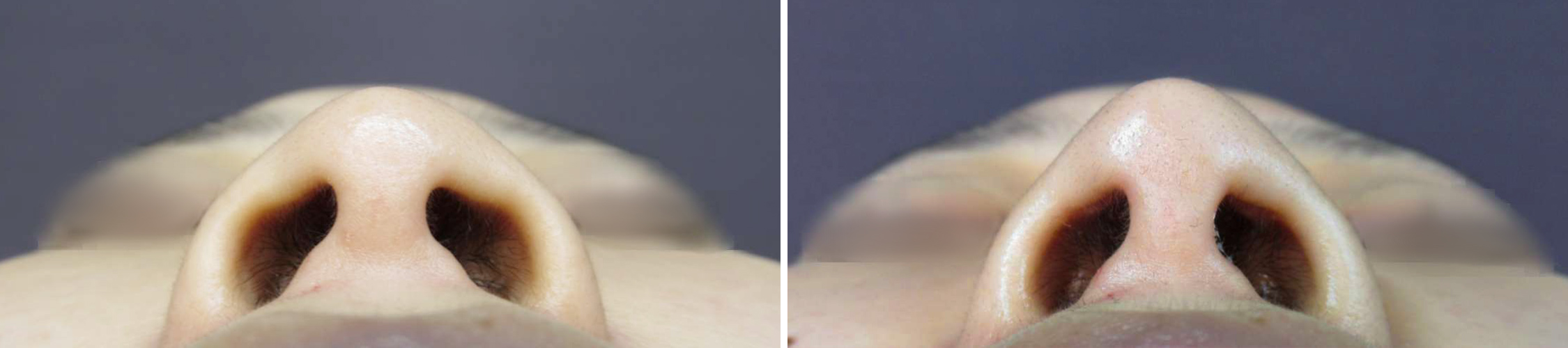 鼻尖形成・鼻尖縮小/鼻尖4Dノーズ/隆鼻術（プロテーゼ・自家組織）の症例写真 施術前後 1ヵ月