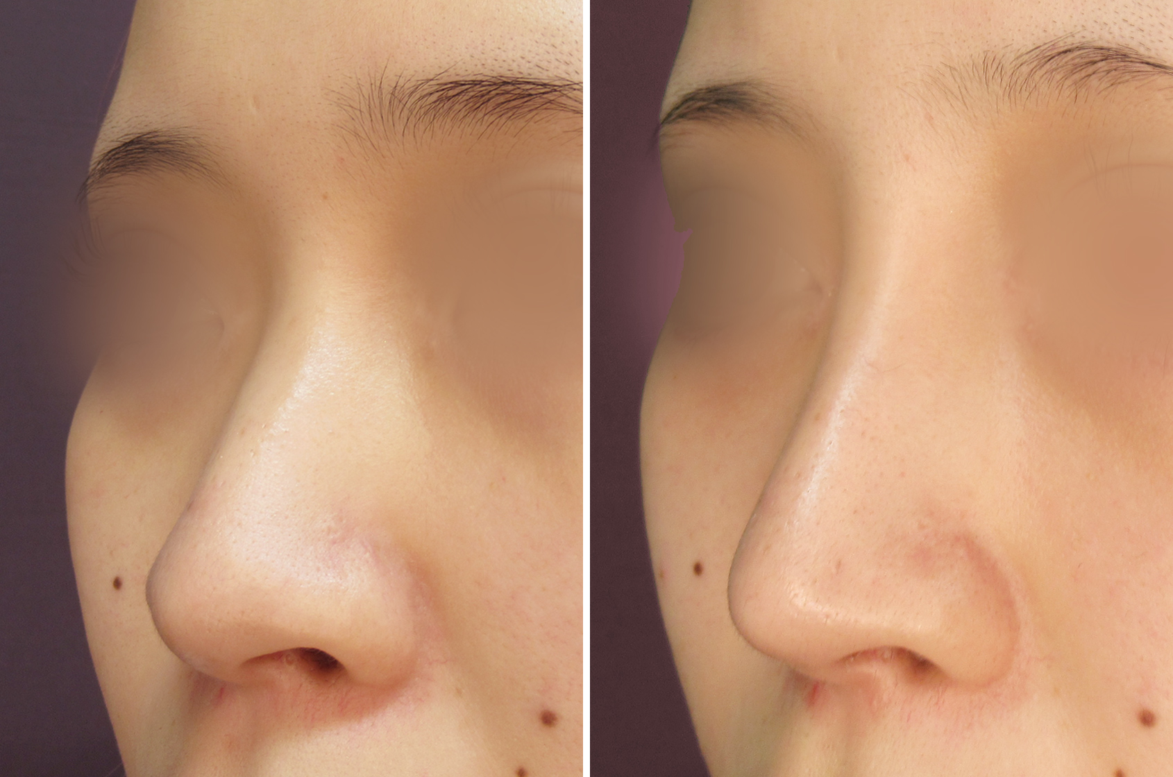 鼻尖形成・鼻尖縮小/鼻尖4Dノーズ/隆鼻術（プロテーゼ・自家組織）の症例写真 施術前後 1ヵ月