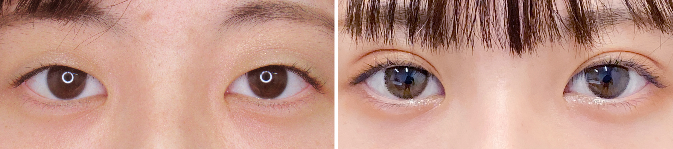 憧れのぱっちり二重に！埋没法1dayナチュラルデザイン オプティマル