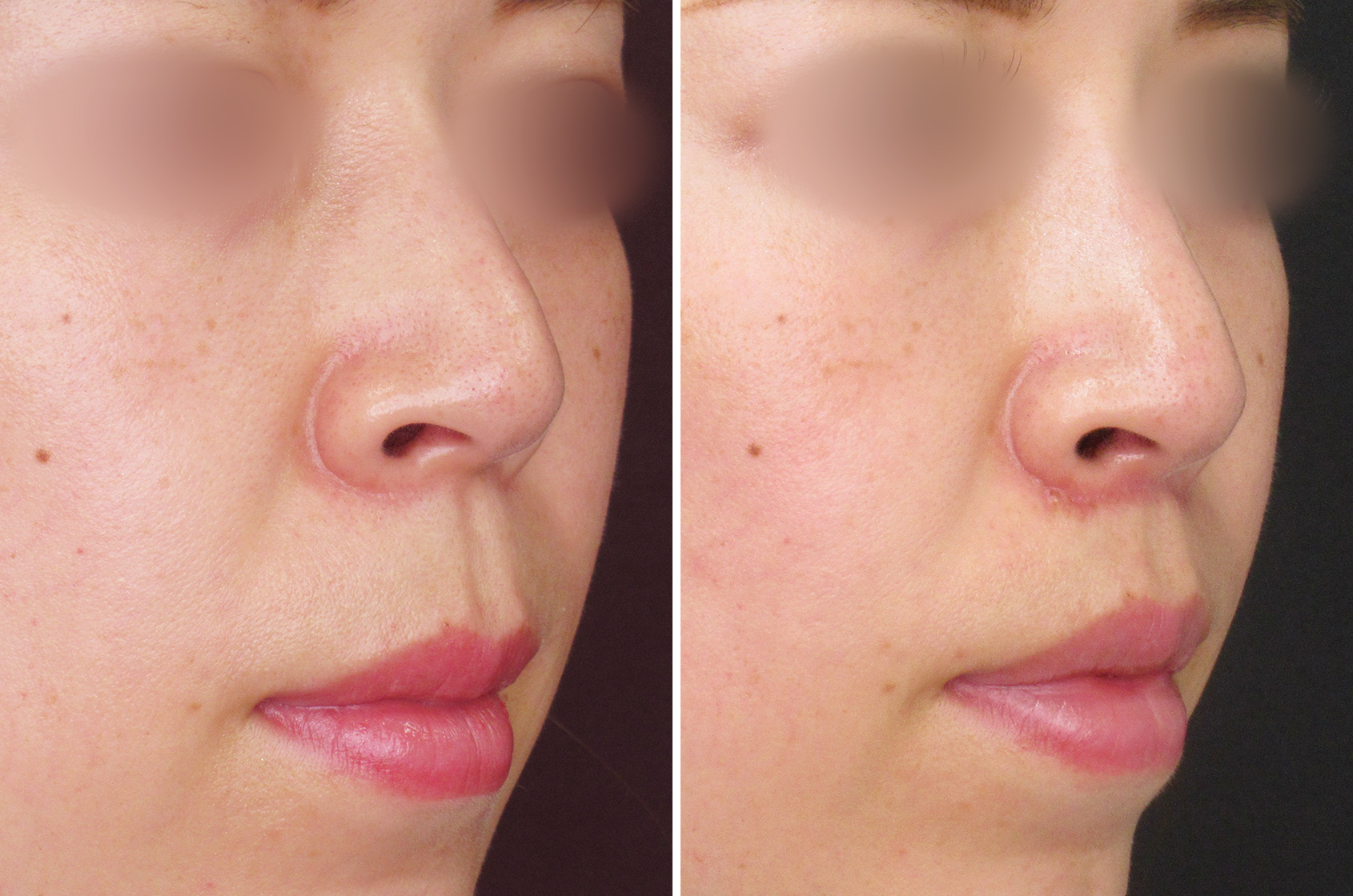 TAC式人中短縮術でかわいらしい口元に