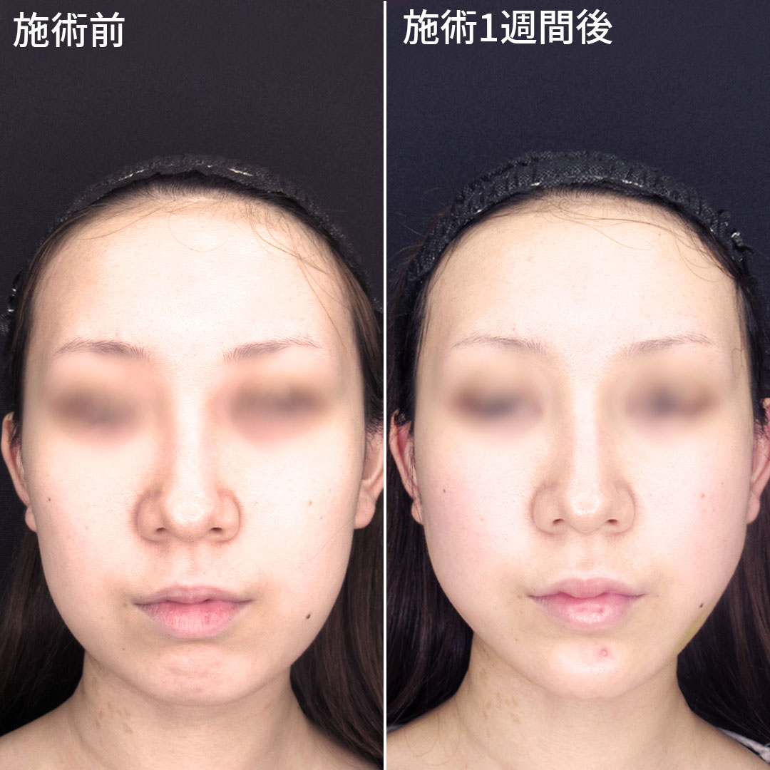 バッカルファット除去とツヤ肌コラーゲンリフトでフェイスラインすっきり