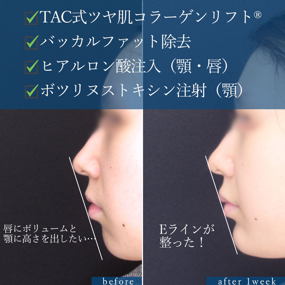 バッカルファット除去/TAC式 ツヤ肌コラーゲンリフト®/顎のヒアルロン酸注射の症例写真 施術前後 
