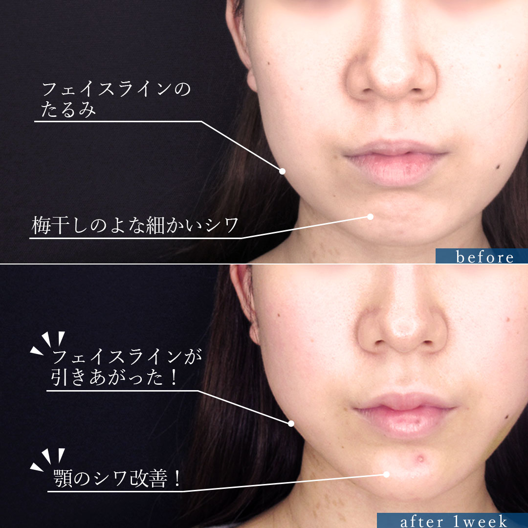 バッカルファット除去/TAC式 ツヤ肌コラーゲンリフト®/顎のヒアルロン酸注射の症例写真 施術前後 