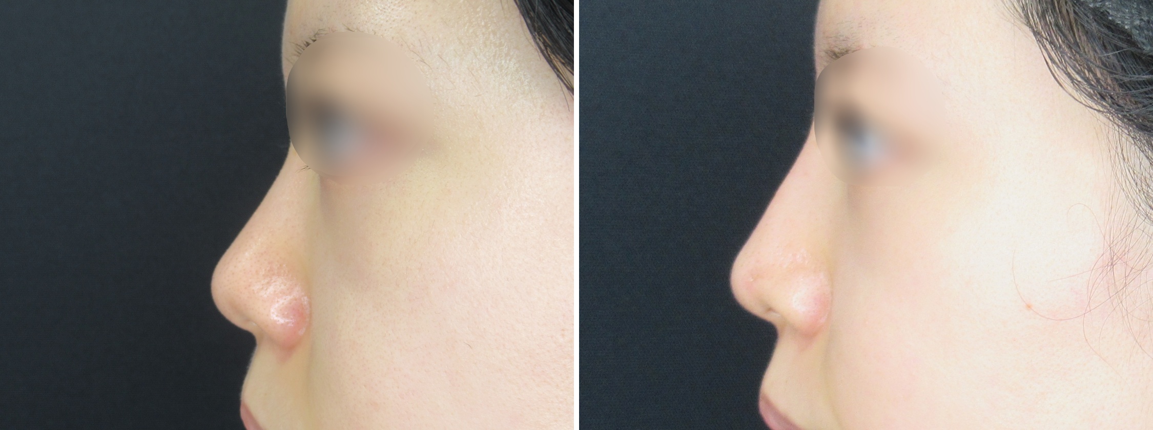 隆鼻術（プロテーゼ・自家組織）/鼻：その他の症例写真 施術前後 1ヵ月