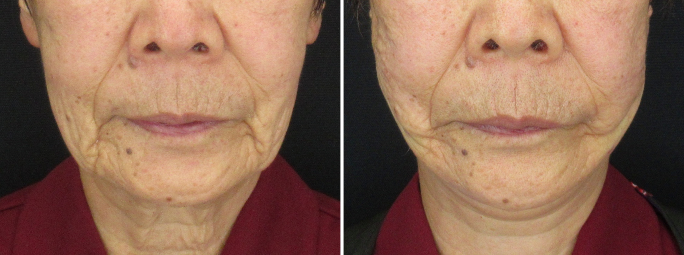 ツヤ肌コラーゲンリフトで80代でもたるみ改善