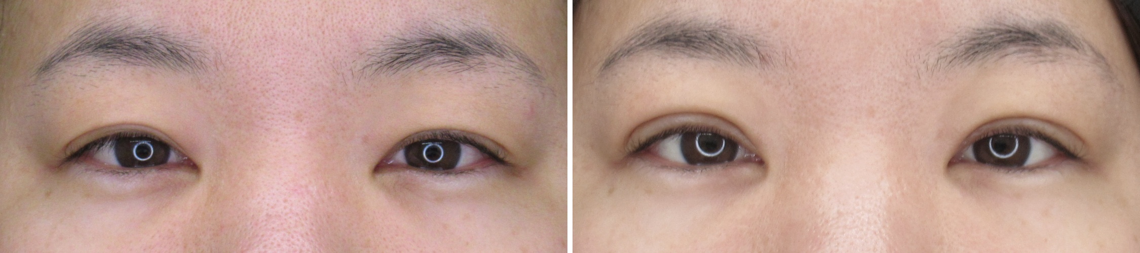 埋没法で自然な二重