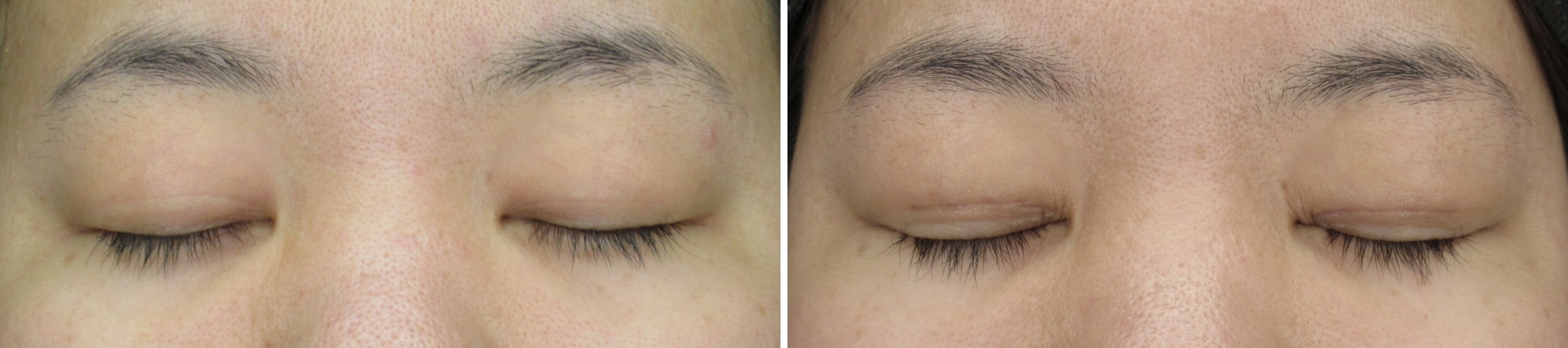 二重埋没法/目元：その他の症例写真 施術前後 １週間