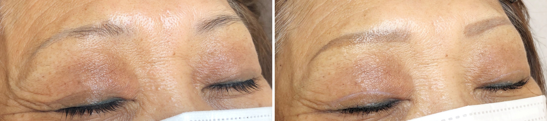 TACメディカルアートメイク（眉・アイライン・リップ）の症例写真 施術前後 1ヵ月