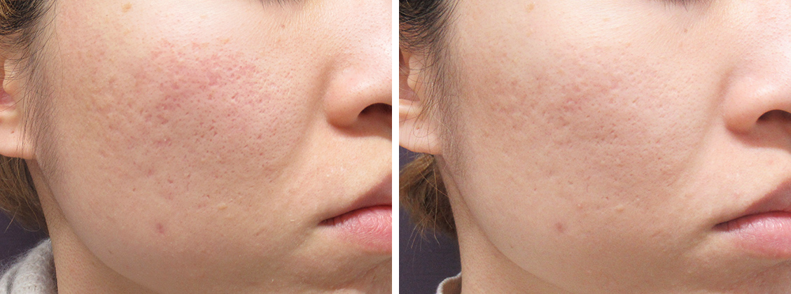 ヴェルヴェットスキンで肌質改善