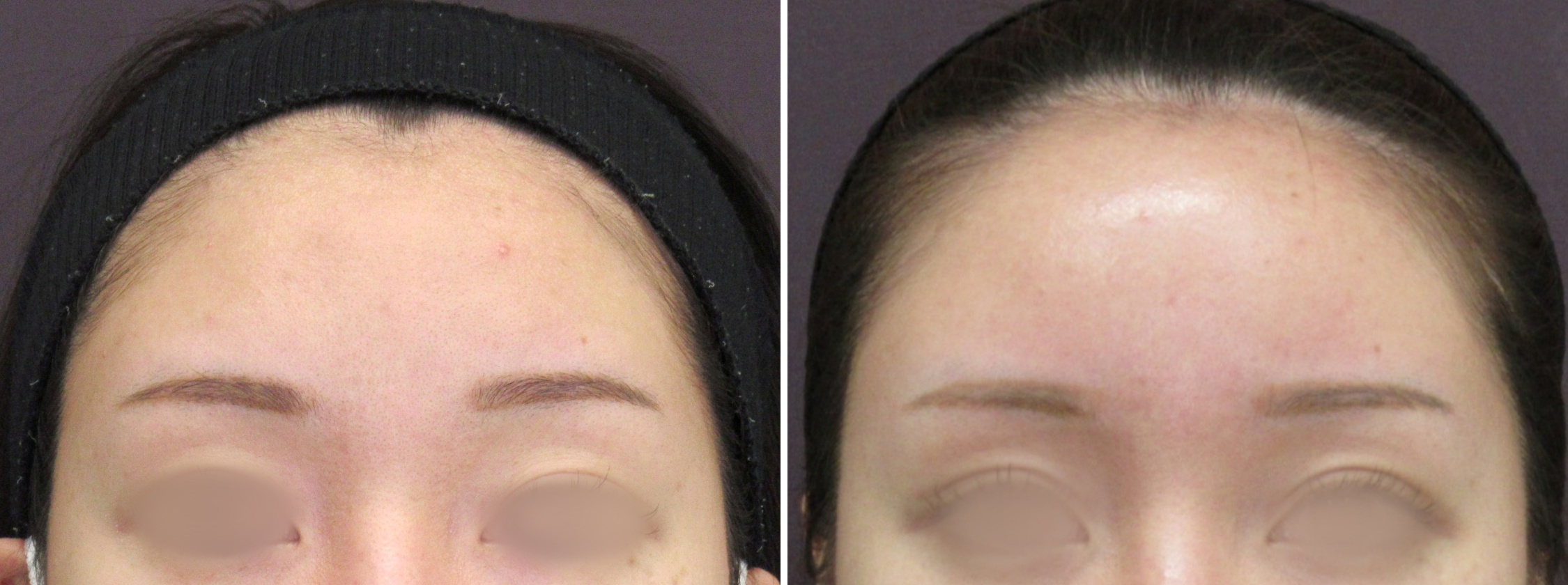 おでこの脂肪注入（オルチャンデコ形成）/顔の脂肪注入(コンデンスリッチフェイス)の症例写真 施術前後 1ヵ月