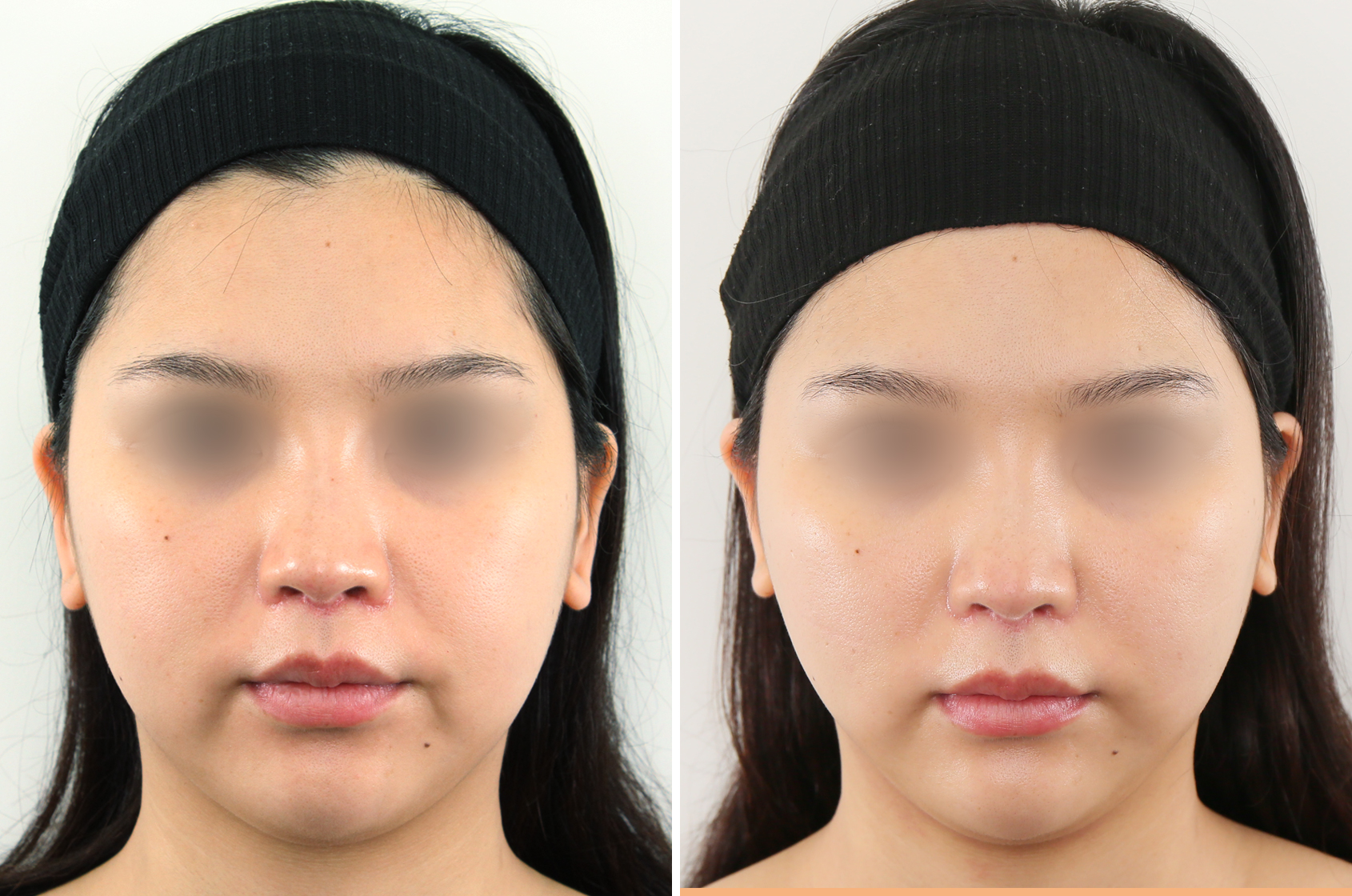 下顎プロテーゼの症例 アゴ整形の症例情報一覧 ダウンタイム Taクリニック 美容整形 美容外科