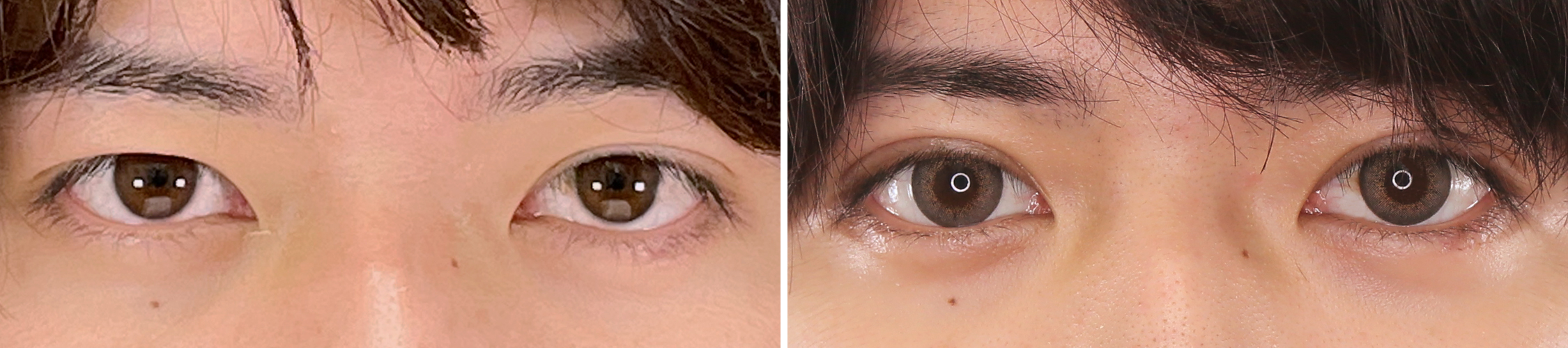 二重埋没法の症例写真 施術前後 1か月