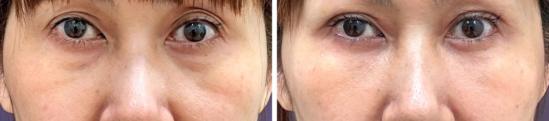 顔の脂肪注入(コンデンスリッチフェイス)/下眼瞼脱脂術（目の下のたるみ取り・目の下の脂肪ふくらみ取り）の症例写真 施術前後 1ヵ月