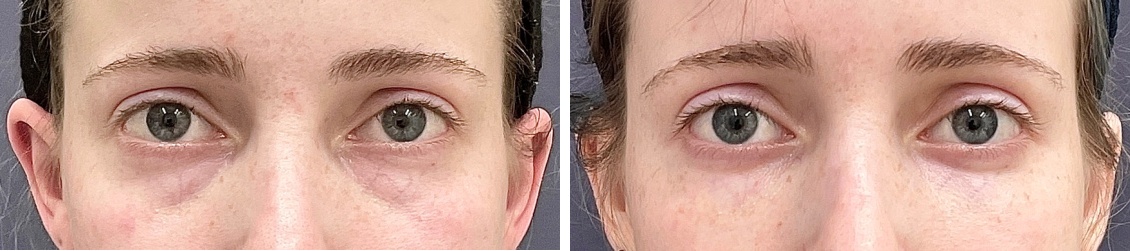 顔の脂肪注入(コンデンスリッチフェイス)/下眼瞼脱脂術（目の下のたるみ取り・目の下の脂肪ふくらみ取り）の症例写真 施術前後 2ヵ月