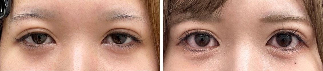 下眼瞼脱脂術+グラマラスライン形成+目尻切開で可愛くなれるタレ目