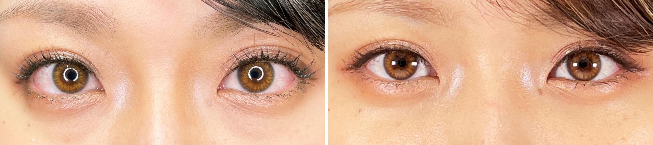 下眼瞼脱脂術とコンデンスリッチフェイスで目元を明るい印象に