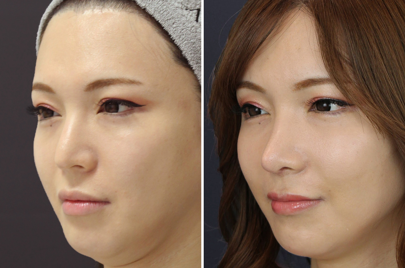 貴族手術（鼻翼基部プロテーゼ・脂肪注入・粉砕肋軟骨移植）/鼻中隔延長術/鼻先軟骨移植の症例写真 施術前後 1ヵ月