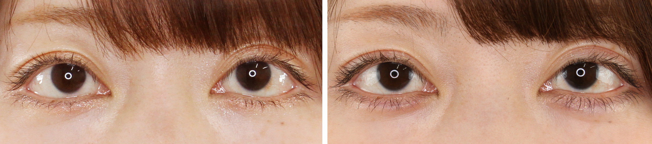 ヒアルロン酸涙袋形成で愛らしいお目元に