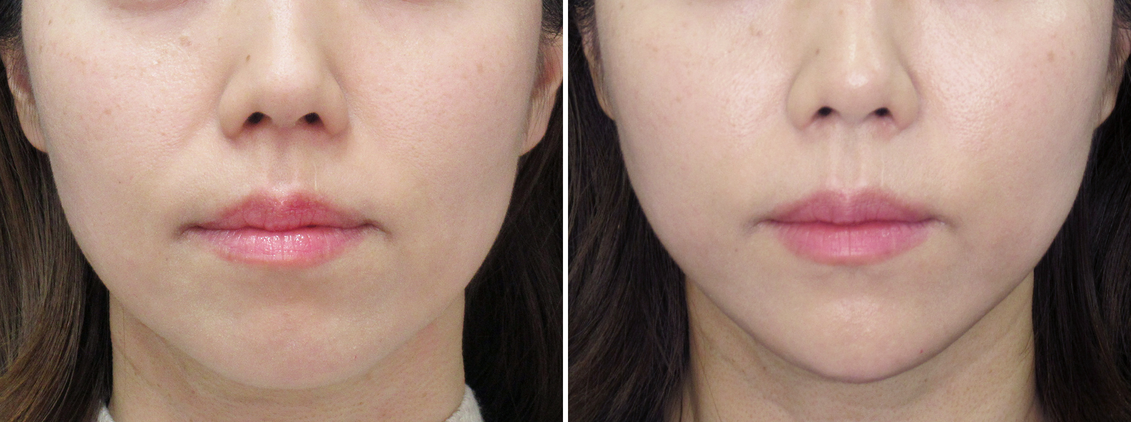 ツヤ肌コラーゲンリフトで目指せ-５歳