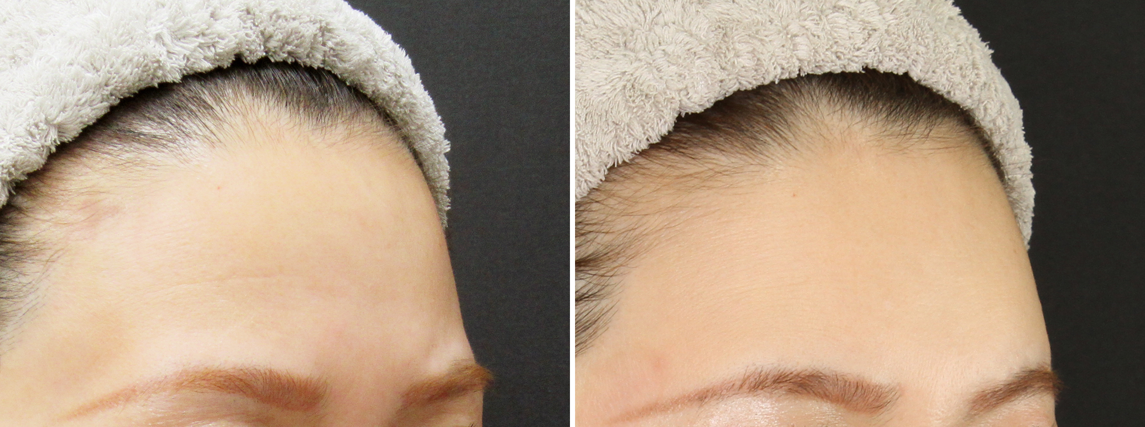 はちみつ注射で横顔美人！オルチャンデコ