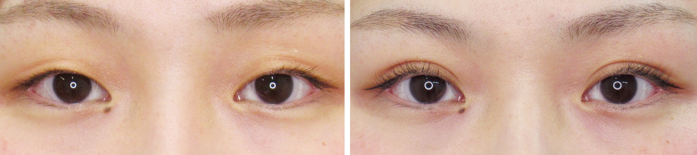 埋没法1dayナチュラルデザイン オプティマルで印象的な目元に