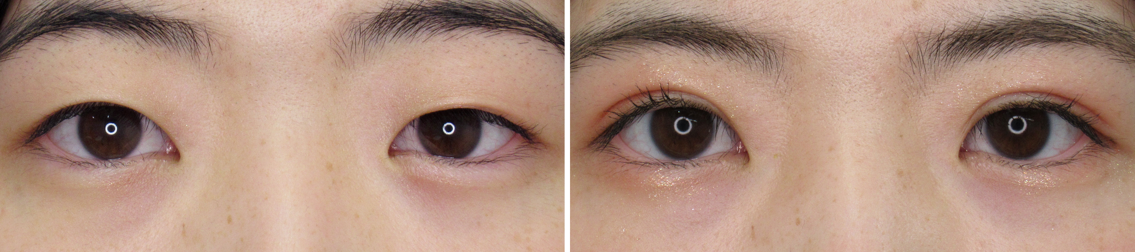 二重埋没法の症例写真 施術前後 1ヶ月