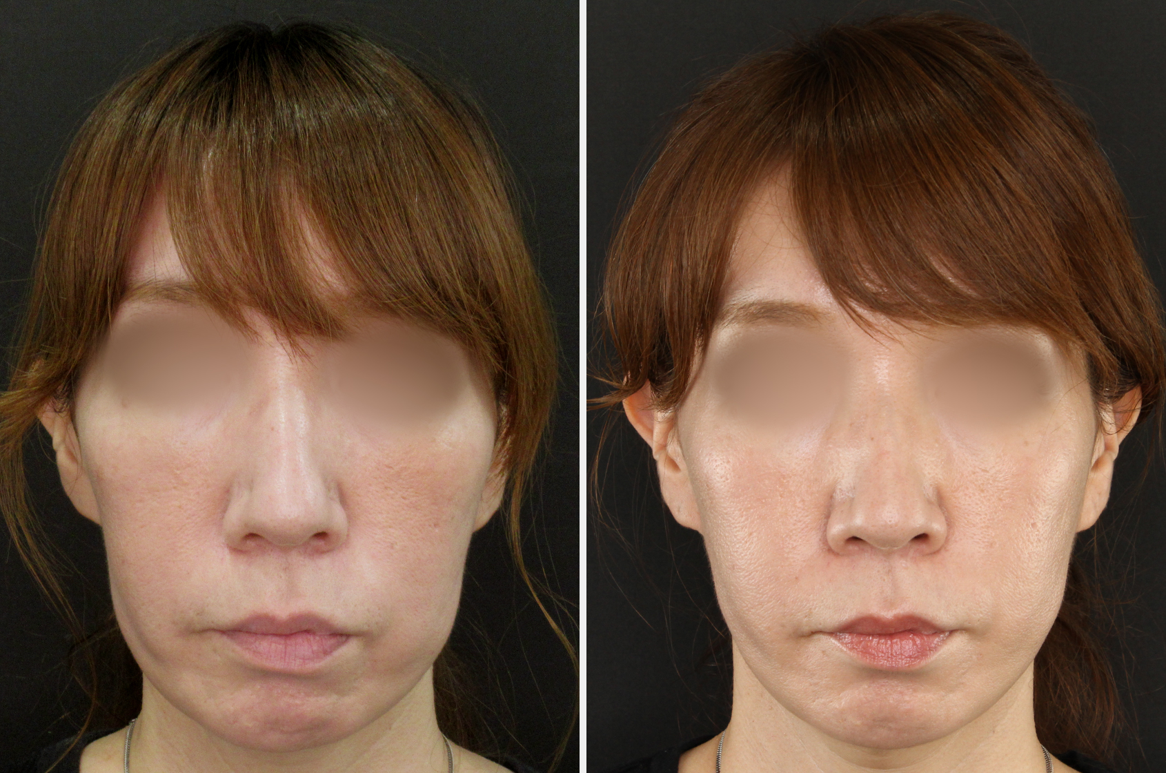 ツヤ肌コラーゲンリフトで頬のたるみを上向きに