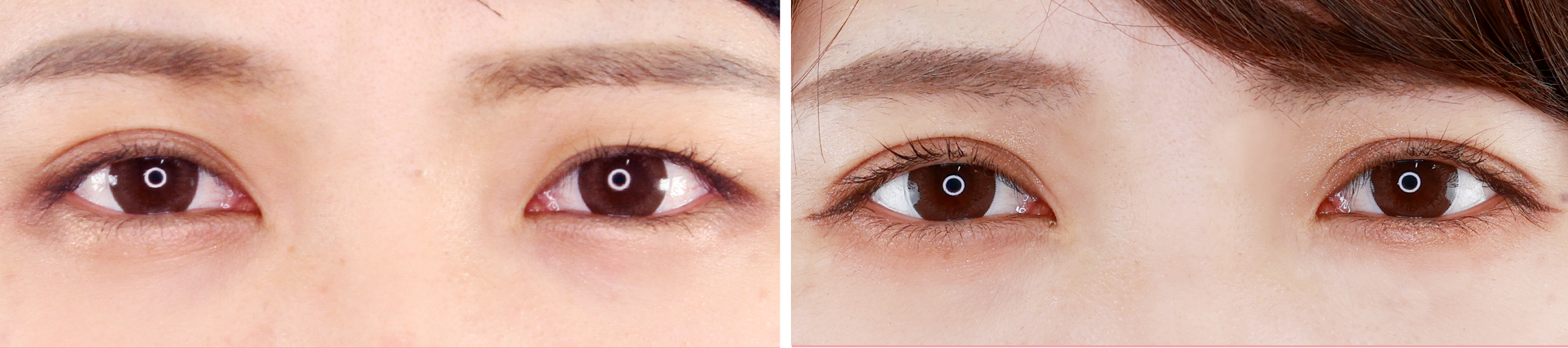 左右差をなくしてどこから見てもぱっちり二重に