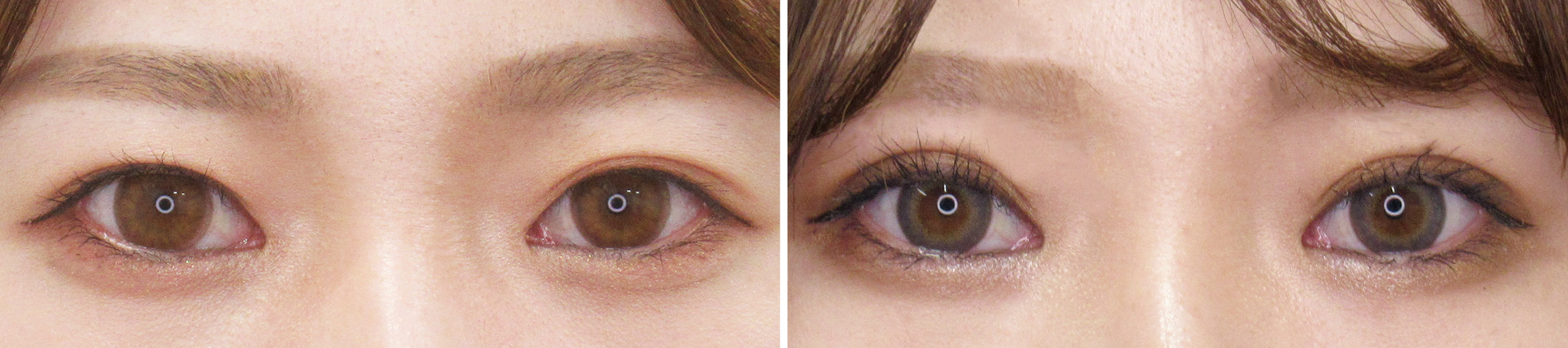 二重埋没法で二重幅をお好み通りに