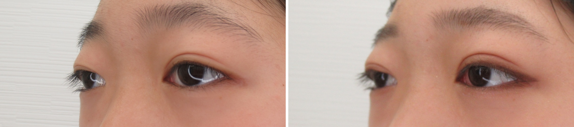 二重埋没法の症例写真 施術前後 １ヵ月