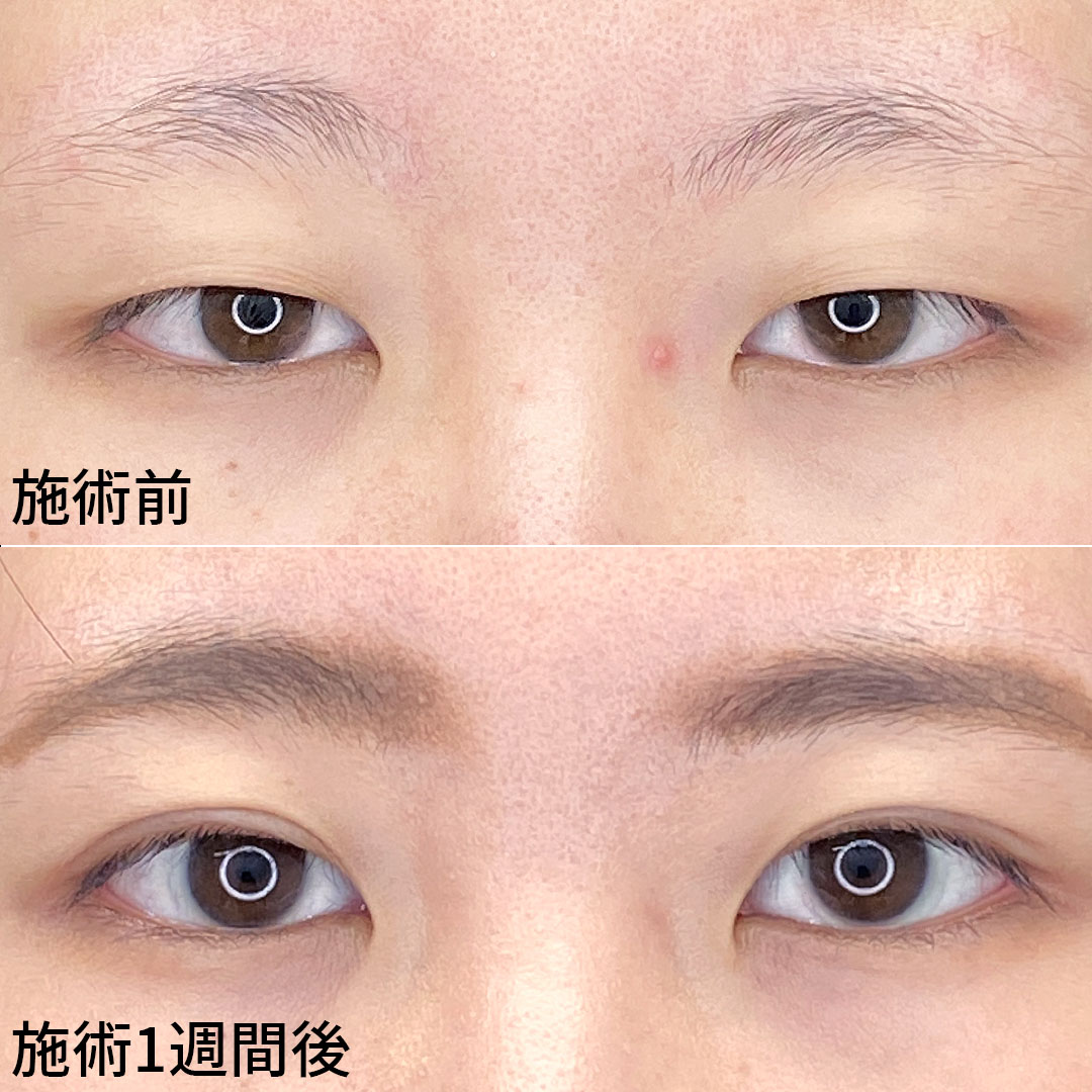 二重埋没法/目元:その他の症例写真 施術前後