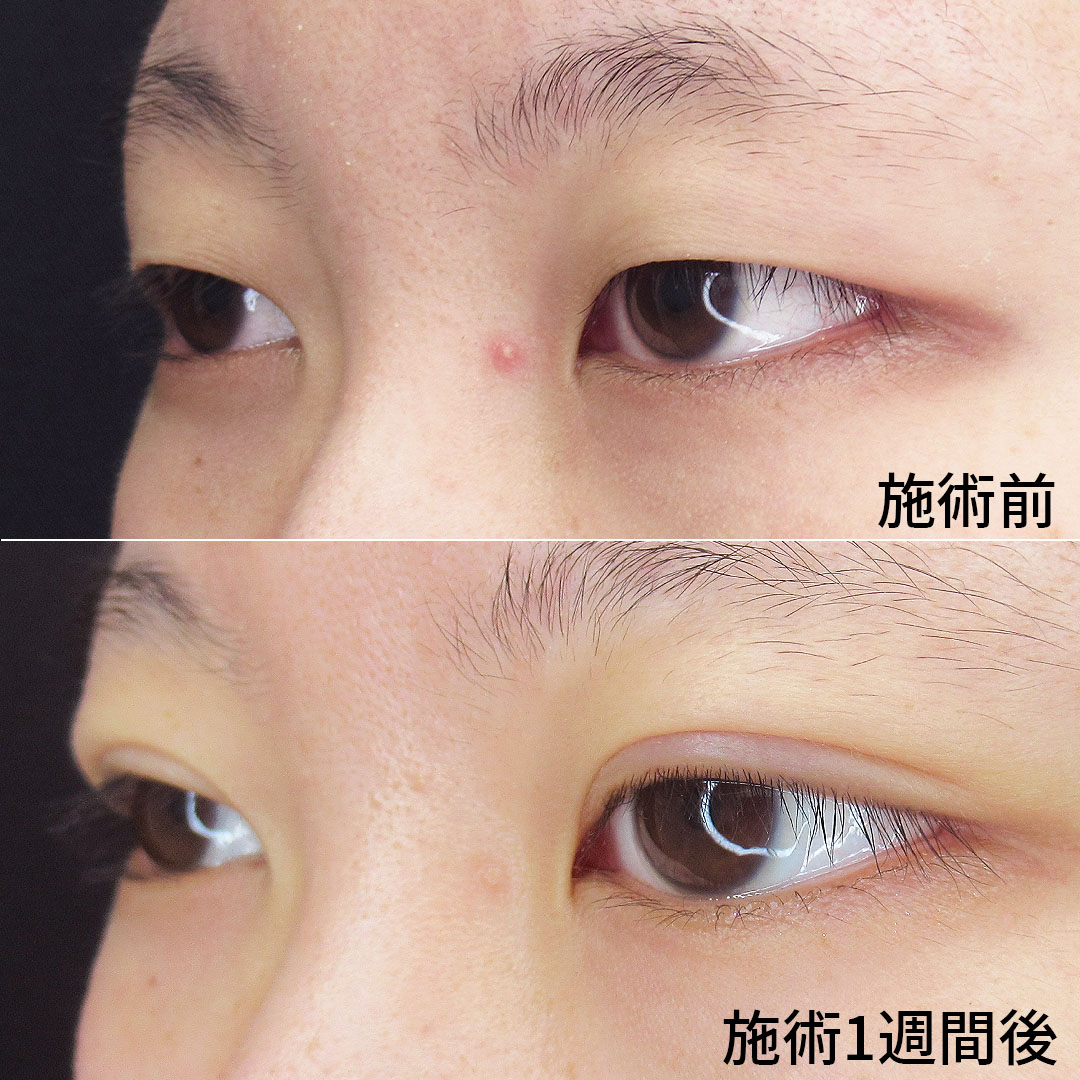 二重埋没法/目元:その他の症例写真 施術前後