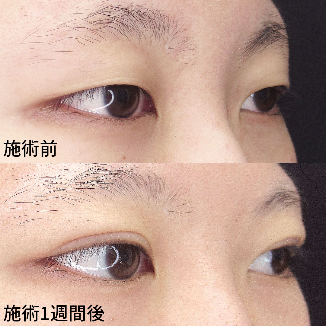 二重埋没法/目元:その他の症例写真 施術前後