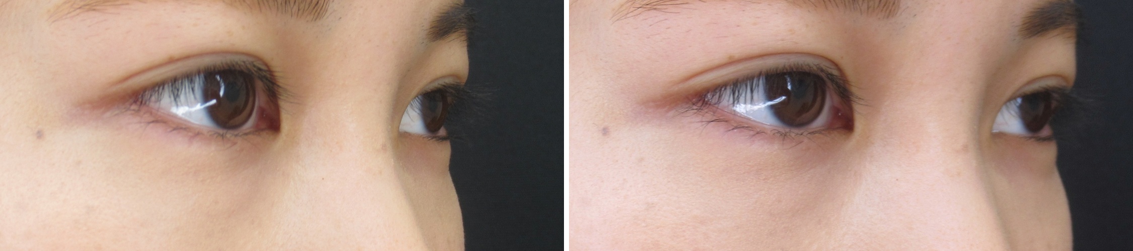 二重埋没法の症例写真 施術前後 1週間