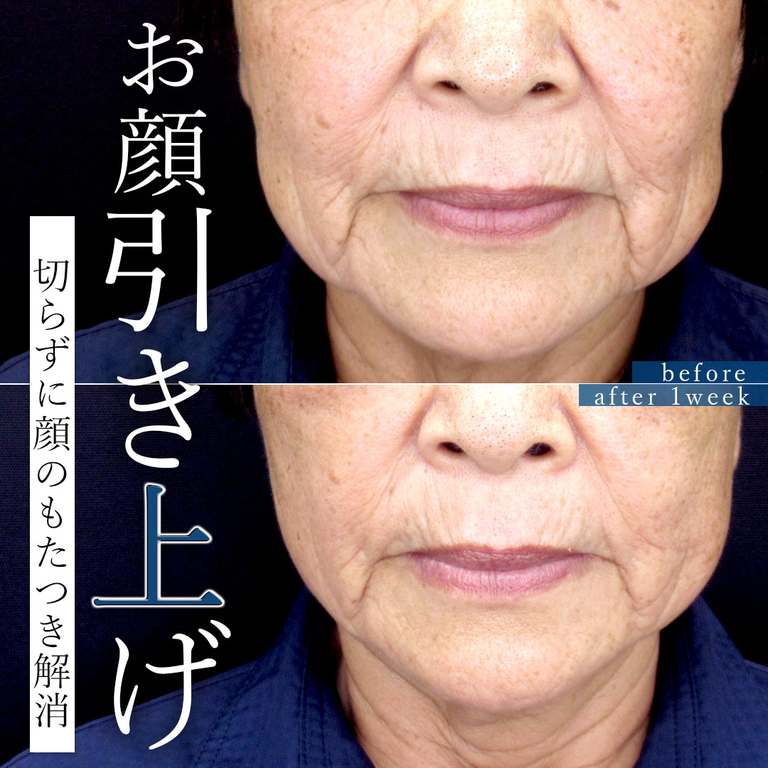 TAC式 ツヤ肌コラーゲンリフト®の症例写真 施術前後